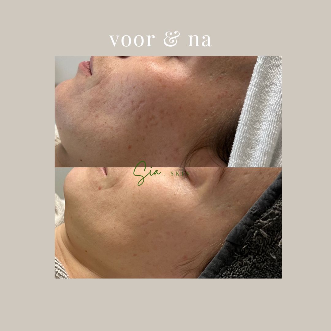 Microneedling: 5 + 1 gratis