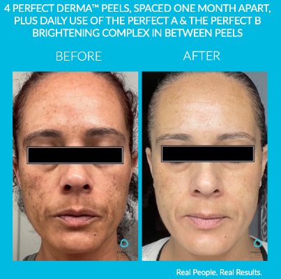 3x pigment peeling kuur kopen = 10% korting