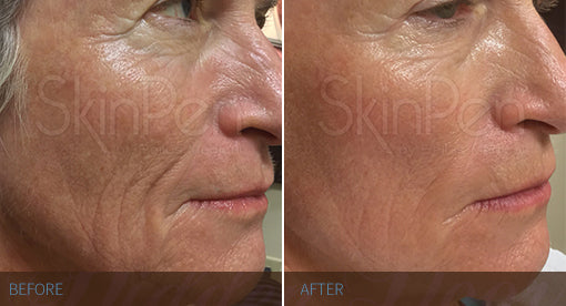 DEELBETALING: 3x microneedling + 3x medische laser lifting behandeling aan 15% korting