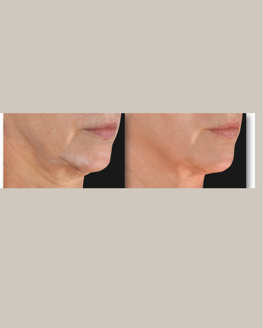 Medische laser lifting behandeling 4x aan 10% korting