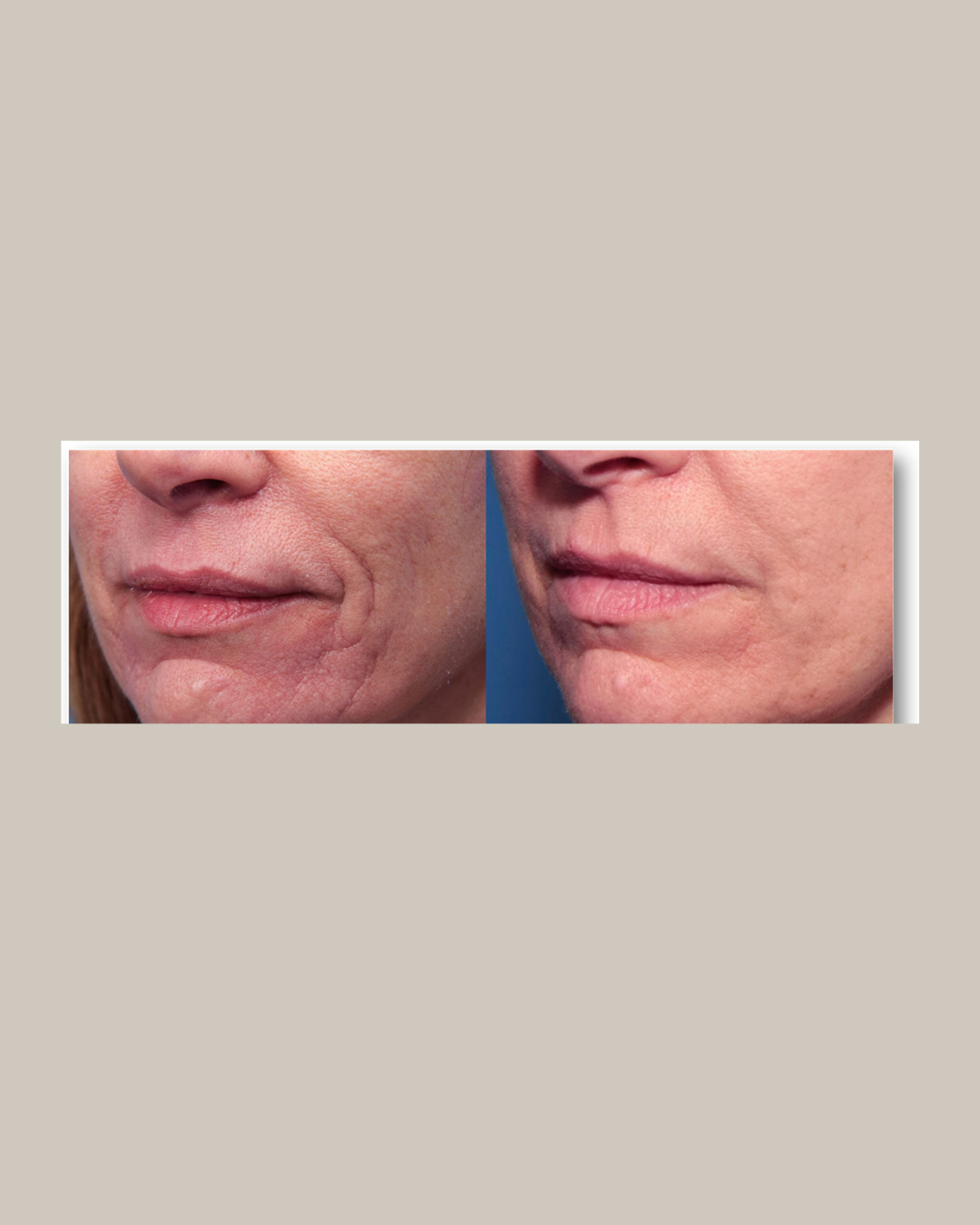 Medische laser lifting behandeling 4x aan  15% korting
