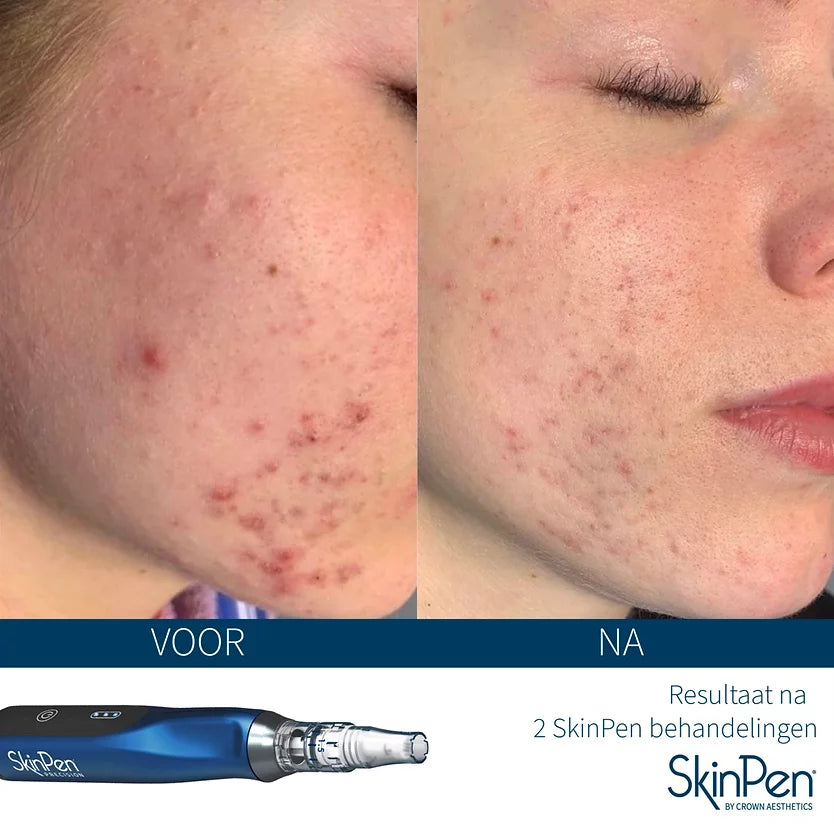 Actie: 3x ANTI-AGE microneedling kopen = 10% korting