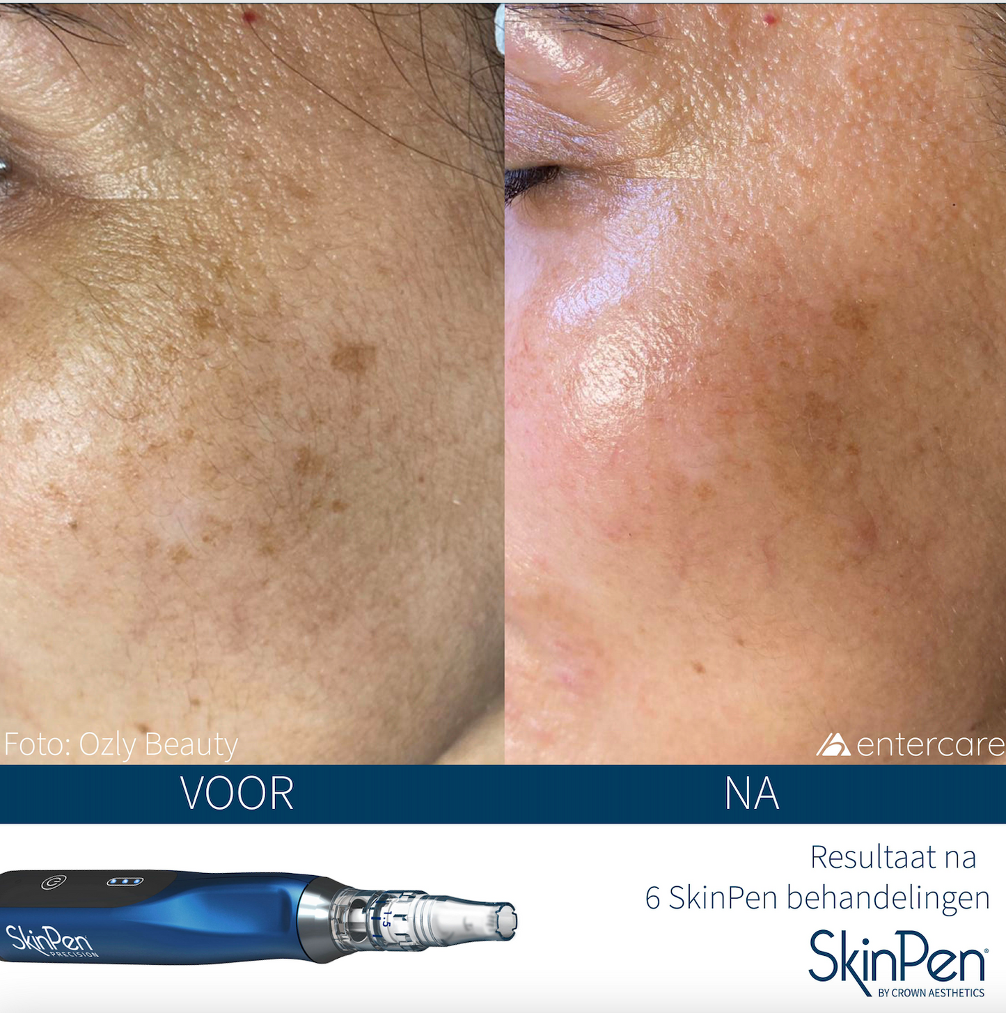 Actie: 3x ANTI-AGE microneedling kopen = 10% korting