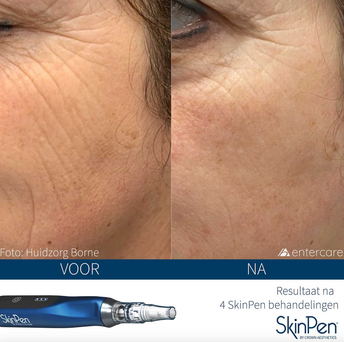 ANTI-AGE Microneedling (extra anti-age booster) : 5 + 1 gratis
